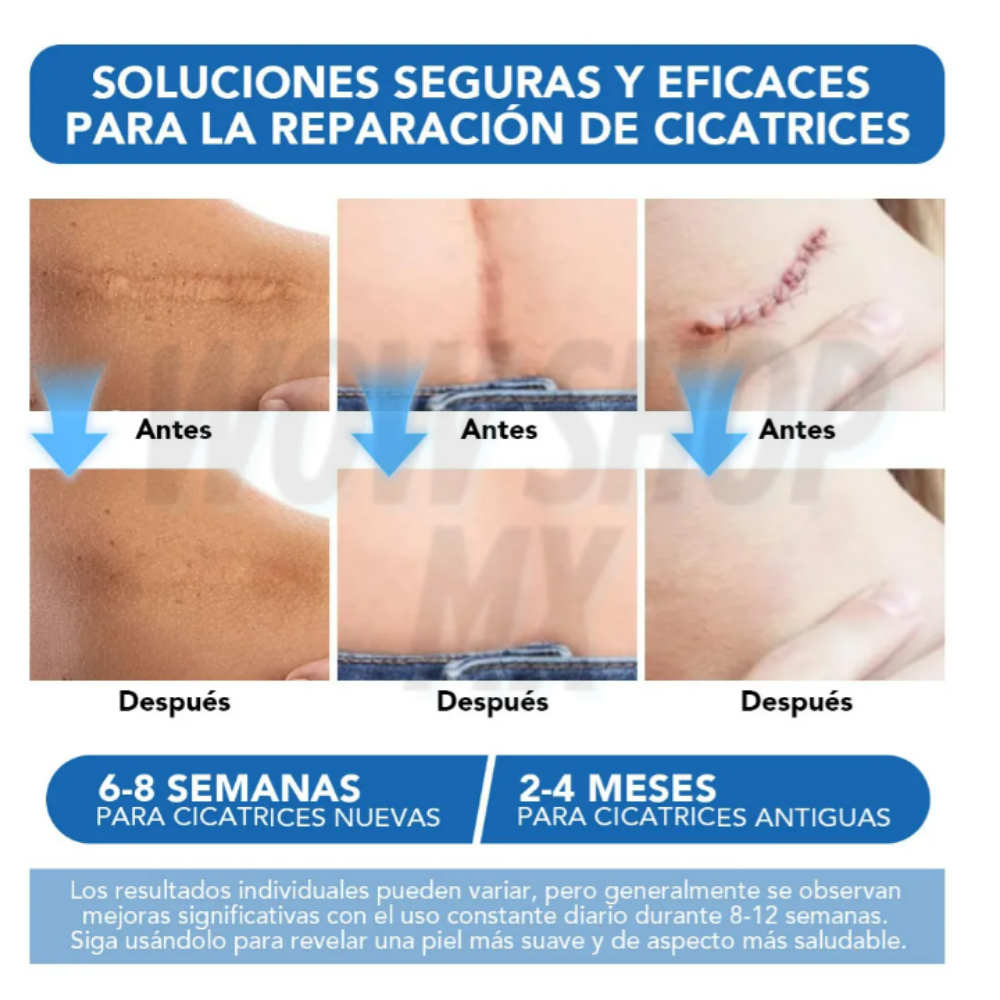 3mts Tira de Silicona para Cicatrices ScarSilk™ – Reduce Cicatrices, Queloides y Marcas Visibles + 🎁 Guía “10 Secretos Dermatológicos para Atenuar Cicatrices y Recuperar la Confianza en tu Piel” + Envío Gratis