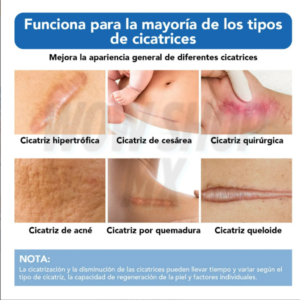 3mts Tira de Silicona para Cicatrices ScarSilk™ – Reduce Cicatrices, Queloides y Marcas Visibles + 🎁 Guía “10 Secretos Dermatológicos para Atenuar Cicatrices y Recuperar la Confianza en tu Piel” + Envío Gratis