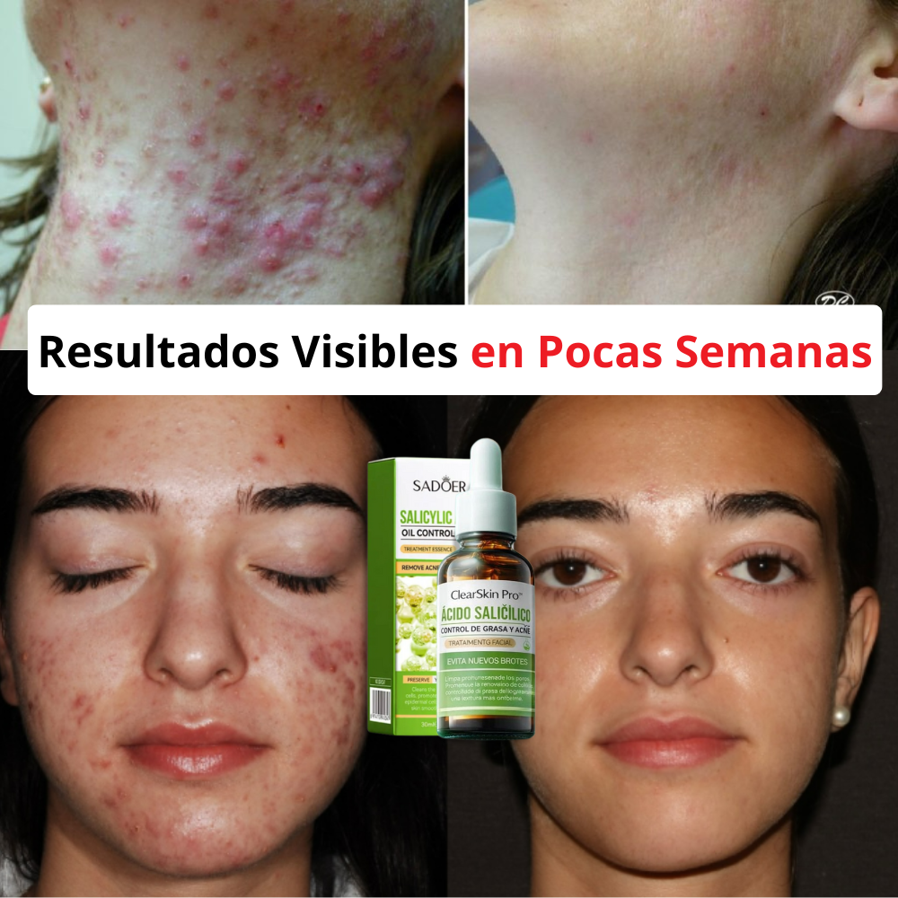 3x1 Suero ClearSkin Pro™ – Sérum de Ácido Salicílico para Acné, Brotes y Poros Obstruidos +🎁 Guía de Seguridad y Autoconfianza GRATIS + Envío Grati