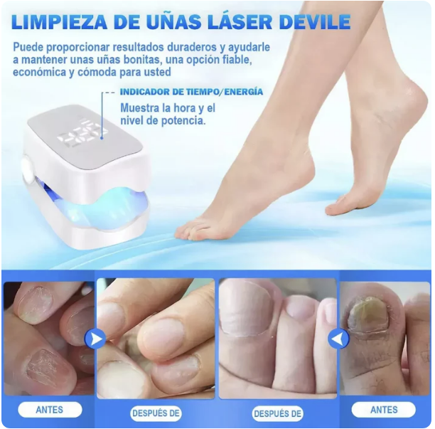 👣 LÁSER PORTÁTIL ELIMINA ONICOMICOSIS EN 7 DIAS✨ – ¡LLÉVATE 2X1 HOY!